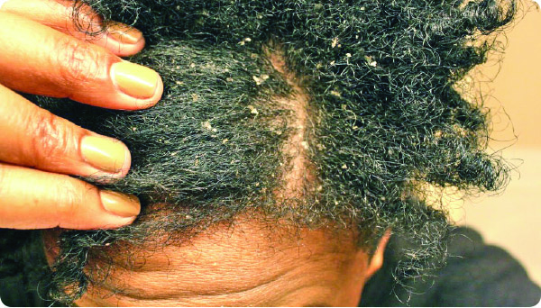 Hair loss: Here are 5 natural ways to treat this condition