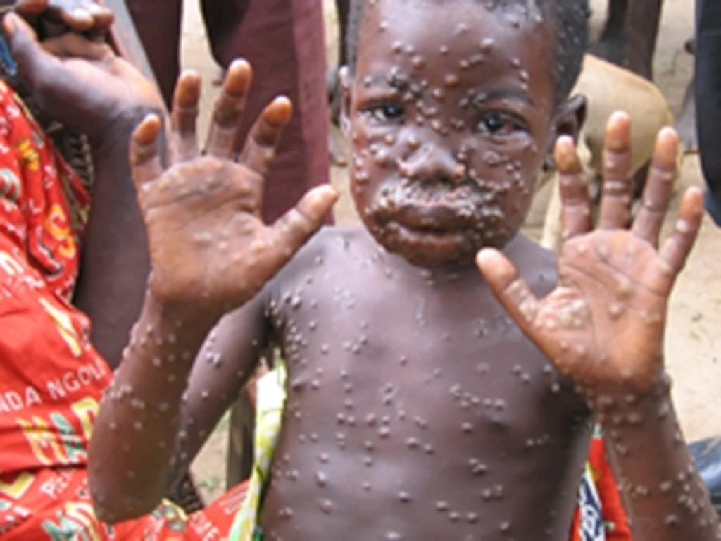 Ghana records 72 suspected monkeypox cases