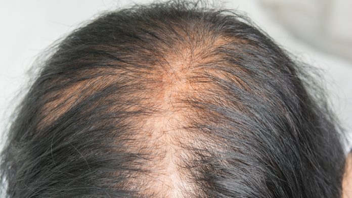 causes of baldness in women