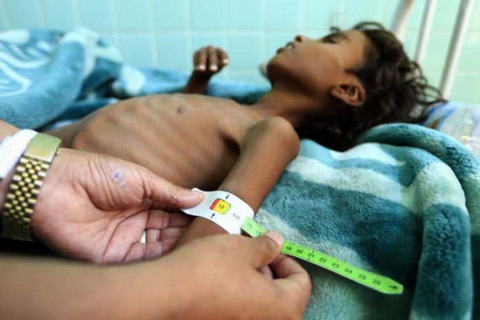 Millions of children in Yemen at risk of malnutrition: warns UNICEF