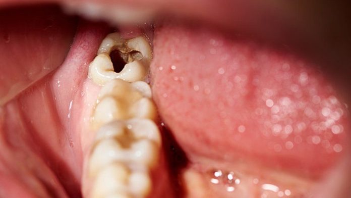 Home remedies for tooth decay and cavities