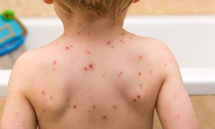 How to deal with chickenpox as an adult 