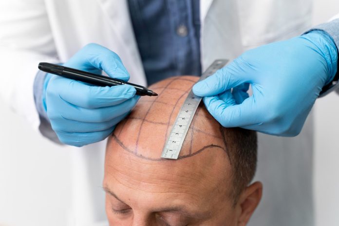 What to expect during a hair transplant procedure