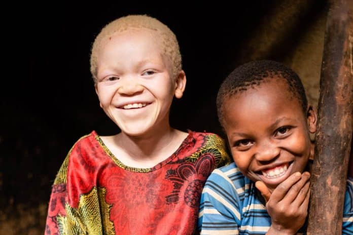 5 types of albinos and how they look